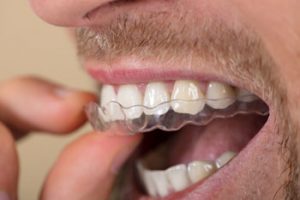 Bruxismo-como-quitar-el-dolor-de-mandibula-Tratamiento-dental