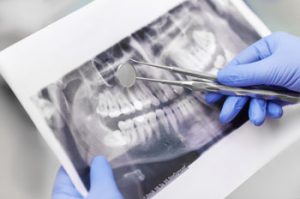 Endodoncia-tratamiento-de-conducto-duele