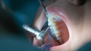 Endodoncia-tratamiento-endodoncia-duele
