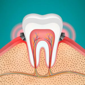 Gingivitis-periodontitis-definicion-y-tratamiento