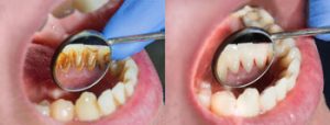 Limpieza-Dental-consulta-valor-examenes-fonasa