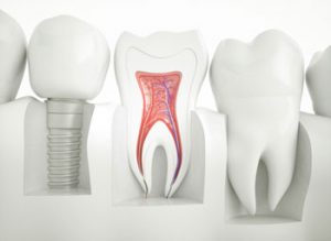 Periodoncia-Dentista-Periodontitis