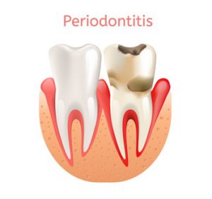 Periodontitis-clinica-dental-Gingivitis-cronica